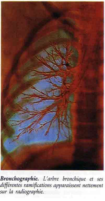 BRONCHIOLE