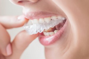 Invisalign : une révolution pour votre dentition