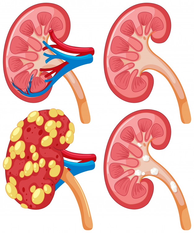 Cancer du rein, métastase du tissu rénal