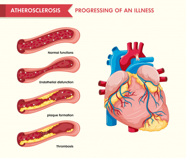 Cœurs artères symptômes et remèdes
