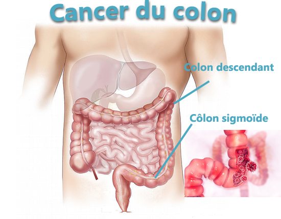 Le cancer du côlon