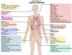 Mieux comprendre la mucoviscidose