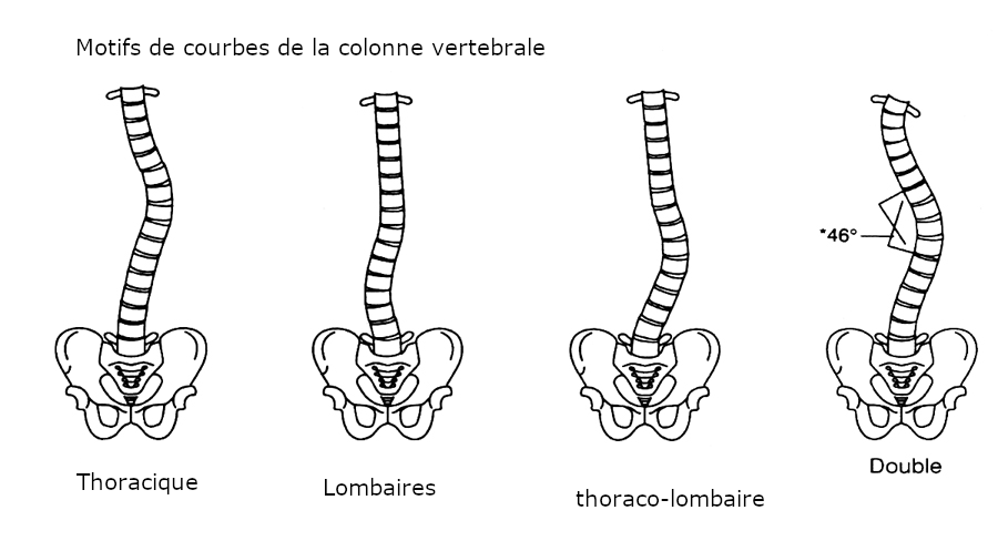 La scoliose