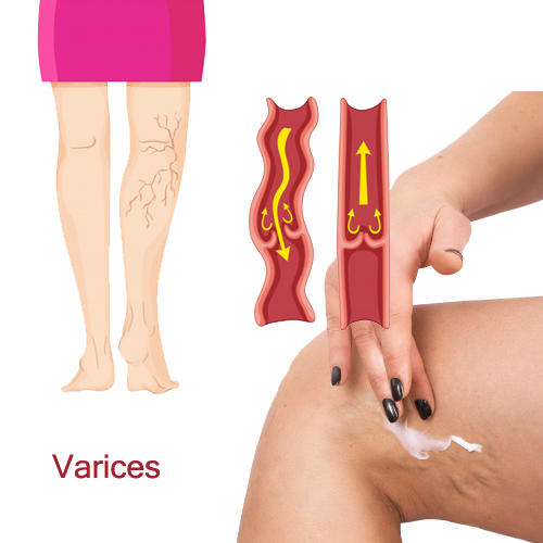 varices maladie veineuse