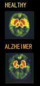 Maladie Alzheimer
