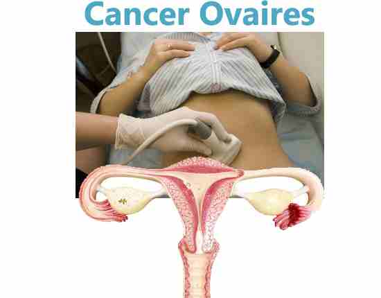 Le cancer de l'ovaire